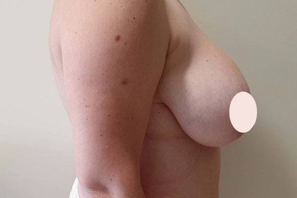 Caso de lifting facial antes