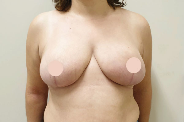 Caso de lifting facial depois