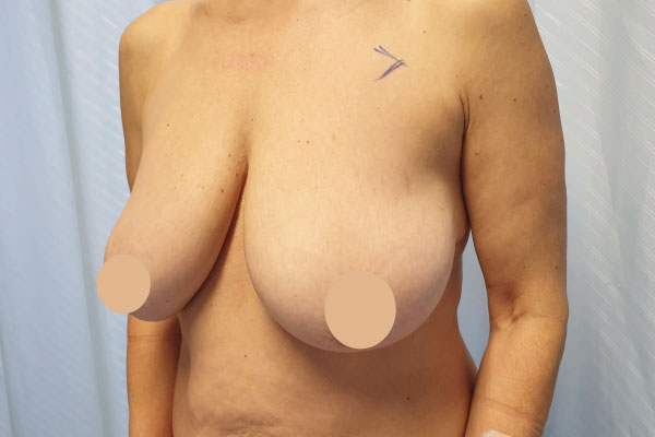 Caso de lifting facial antes