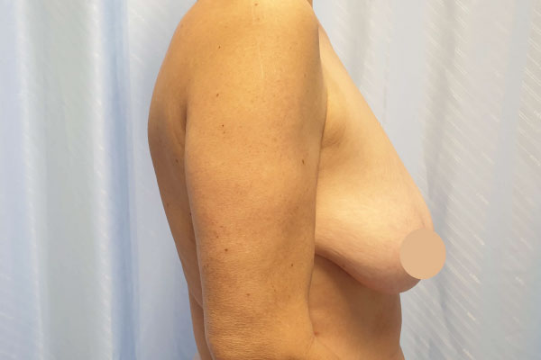 Caso de lifting facial antes