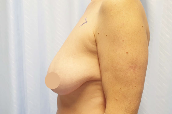 Caso de lifting facial antes