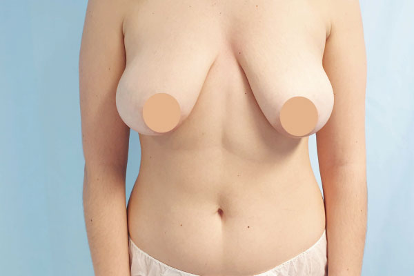 Caso de lifting facial antes