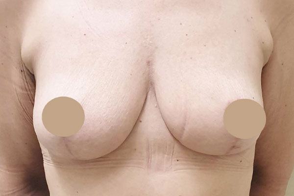 Caso de lifting facial depois