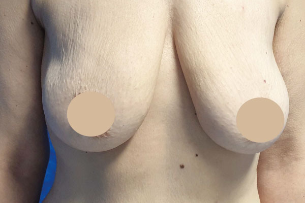 Caso de lifting facial antes