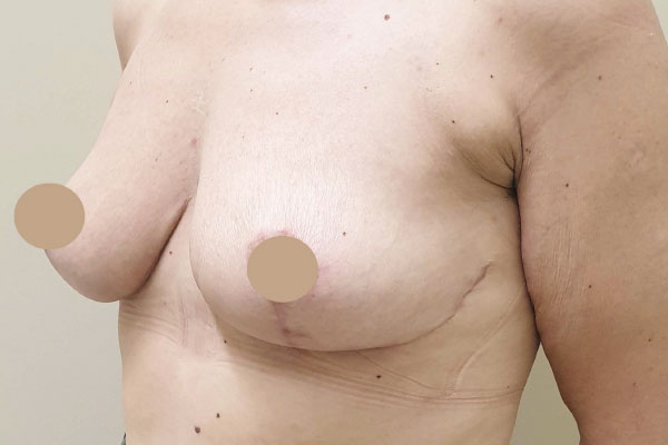 Caso de lifting facial depois