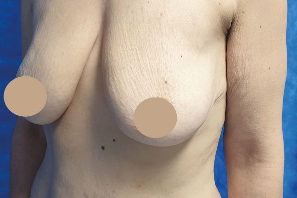 Caso de lifting facial antes