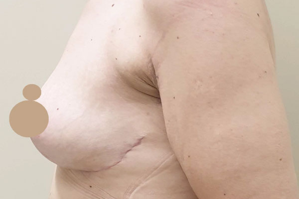 Caso de lifting facial depois