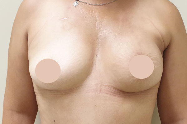 Caso de lifting facial depois