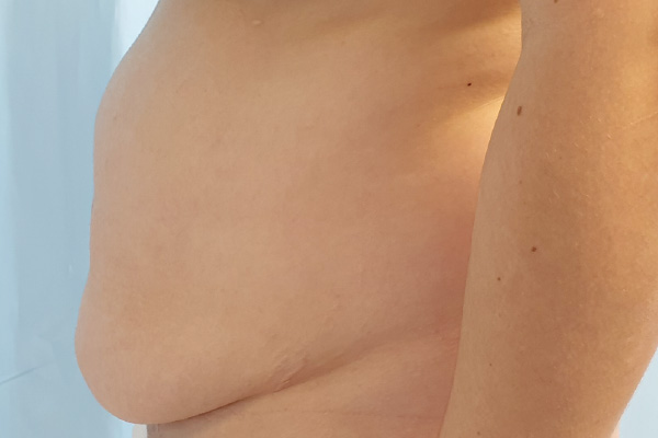 Caso de lifting facial antes