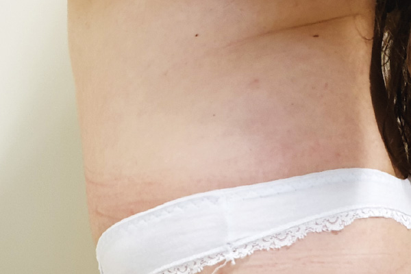 Caso de lifting facial depois