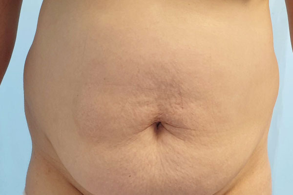 Caso de lifting facial antes