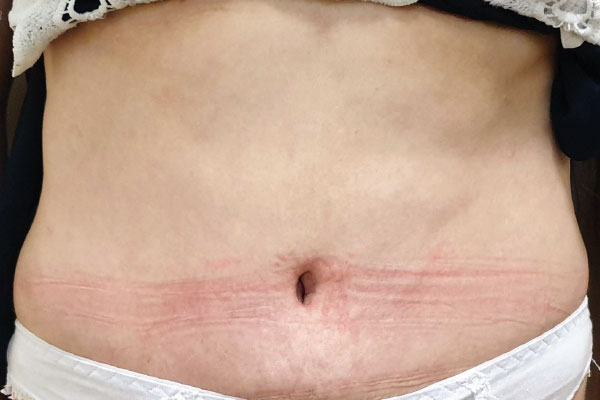 Caso de lifting facial depois