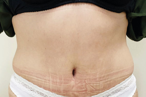 Caso de lifting facial depois