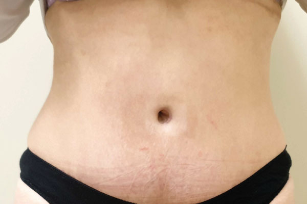 Caso de lifting facial depois