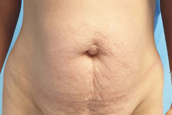 Caso de lifting facial antes