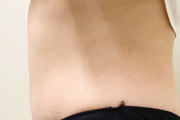 Caso de lifting facial depois