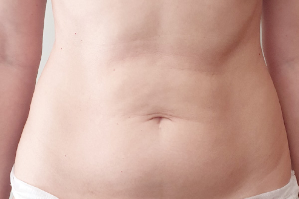 Caso de lifting facial antes