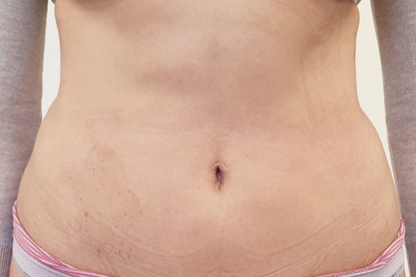 Caso de lifting facial depois