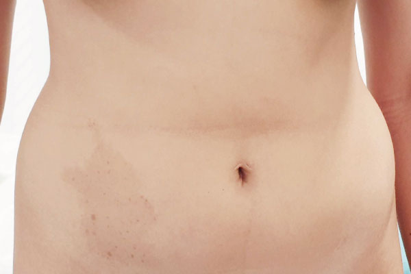 Caso de lifting facial antes