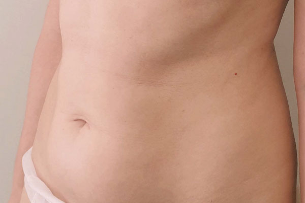 Caso de lifting facial antes