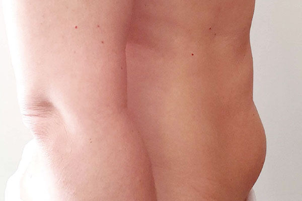 Caso de lifting facial antes