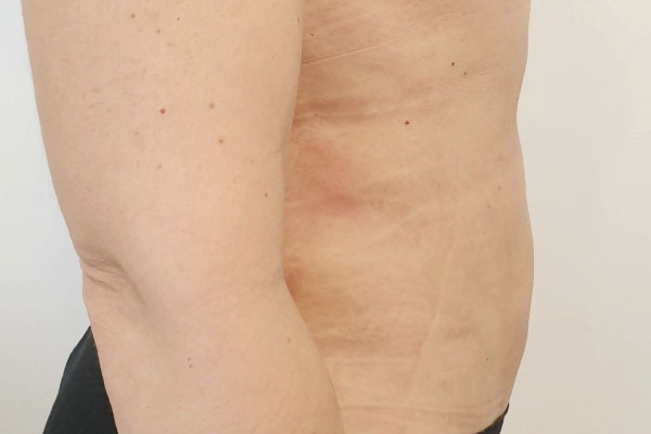 Caso de lifting facial depois