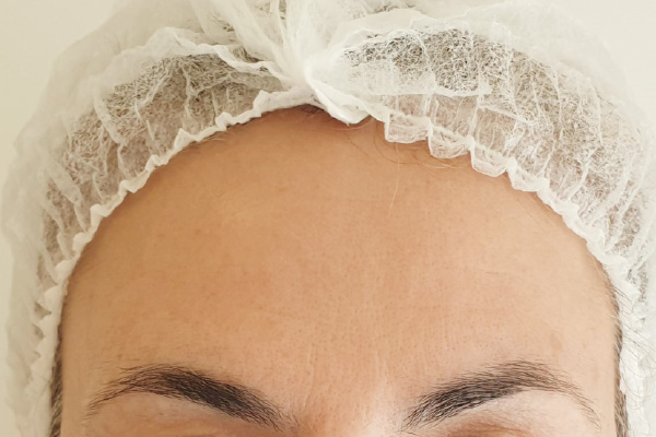 Caso de lifting facial depois