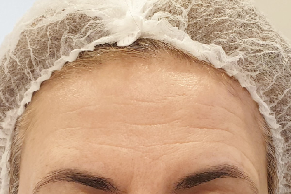 Caso de lifting facial antes