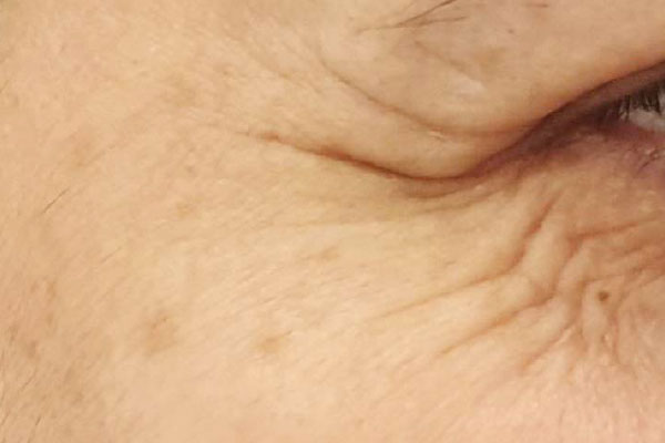 Caso de lifting facial antes