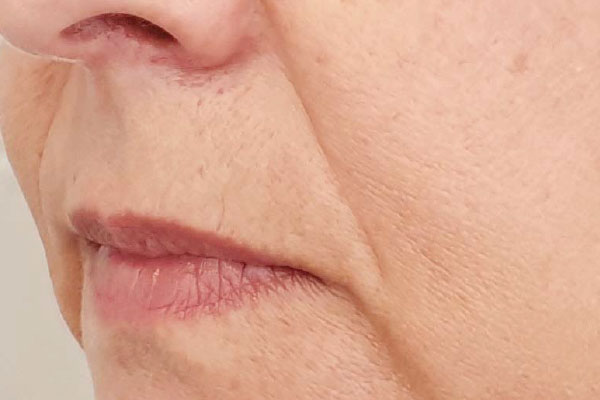 Caso de lifting facial antes