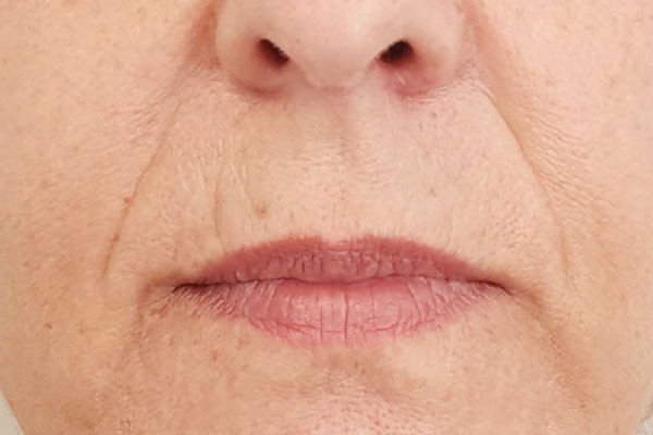 Caso de lifting facial antes