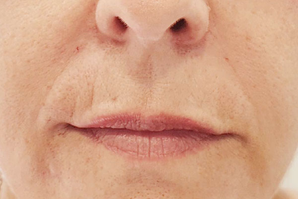 Caso de lifting facial depois