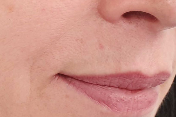 Caso de lifting facial depois