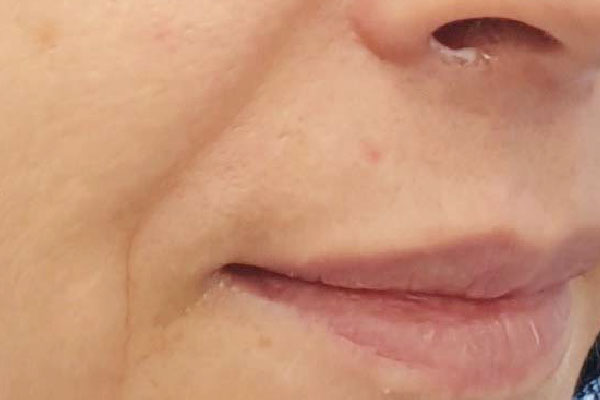 Caso de lifting facial antes