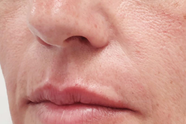 Caso de lifting facial depois