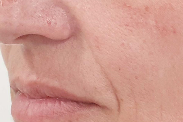 Caso de lifting facial antes