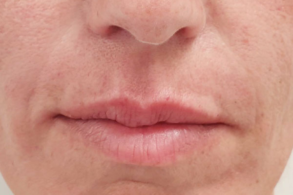 Caso de lifting facial depois