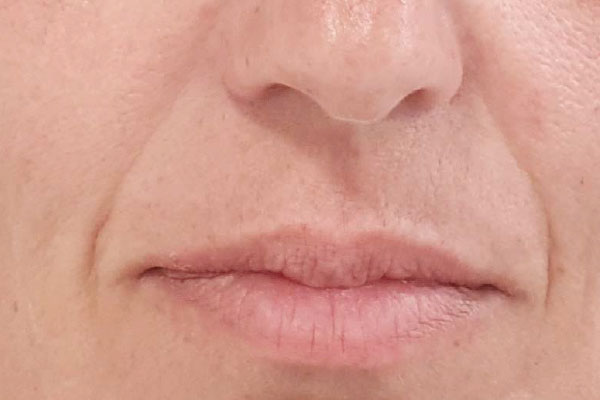 Caso de lifting facial antes