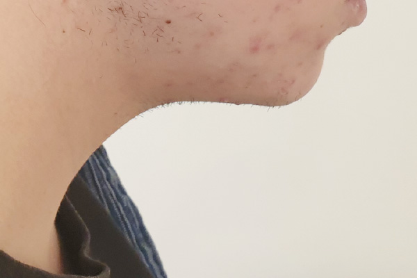 Caso de lifting facial depois