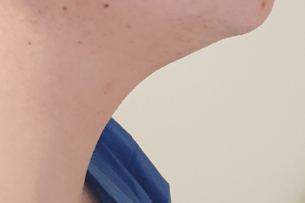 Caso de lifting facial antes