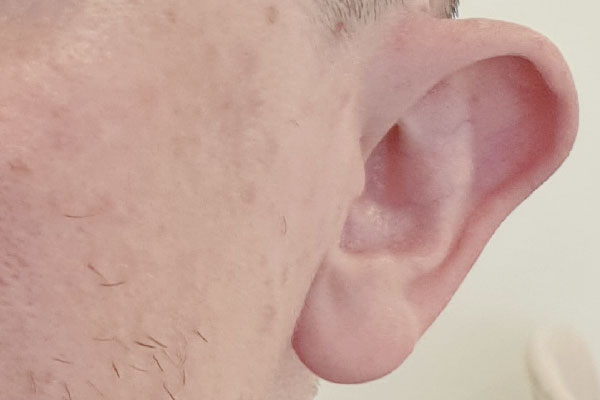 Caso de lifting facial antes