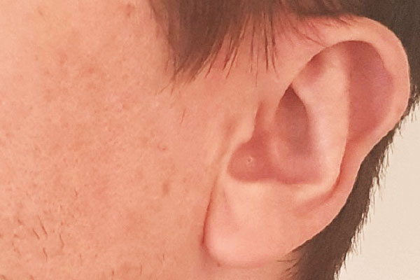 Caso de lifting facial depois