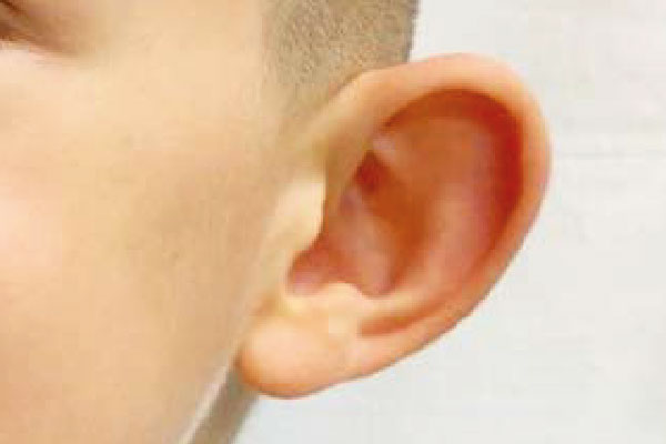 Caso de lifting facial antes