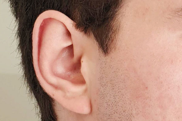 Caso de lifting facial antes