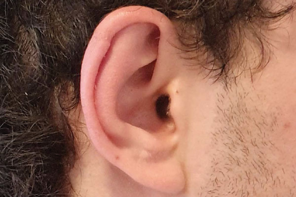 Caso de lifting facial depois