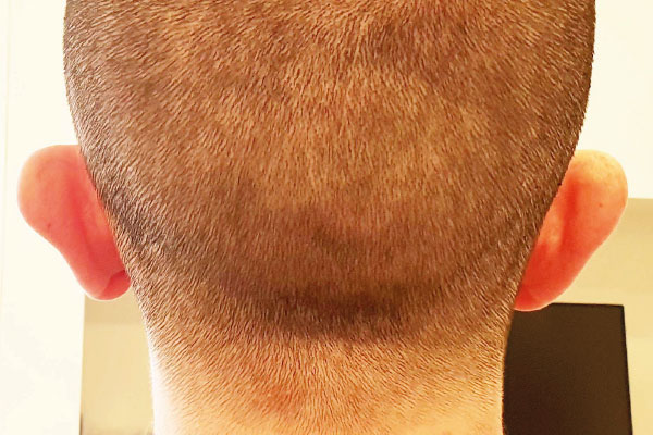 Caso de lifting facial antes