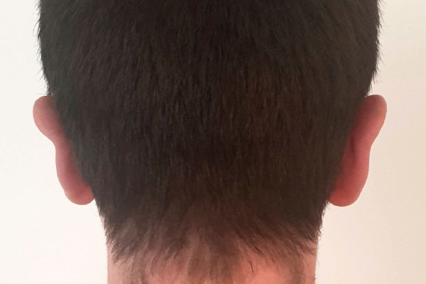 Caso de lifting facial depois