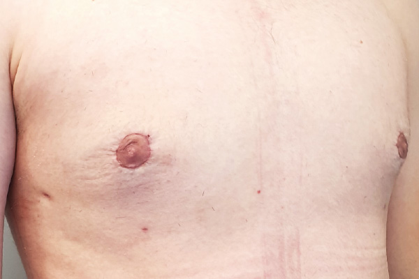 Caso de lifting facial depois