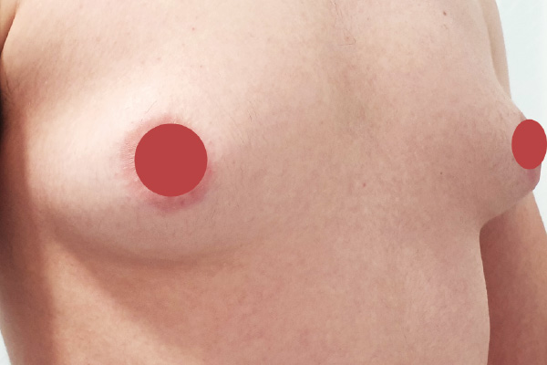 Caso de lifting facial antes