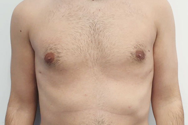 Caso de lifting facial depois